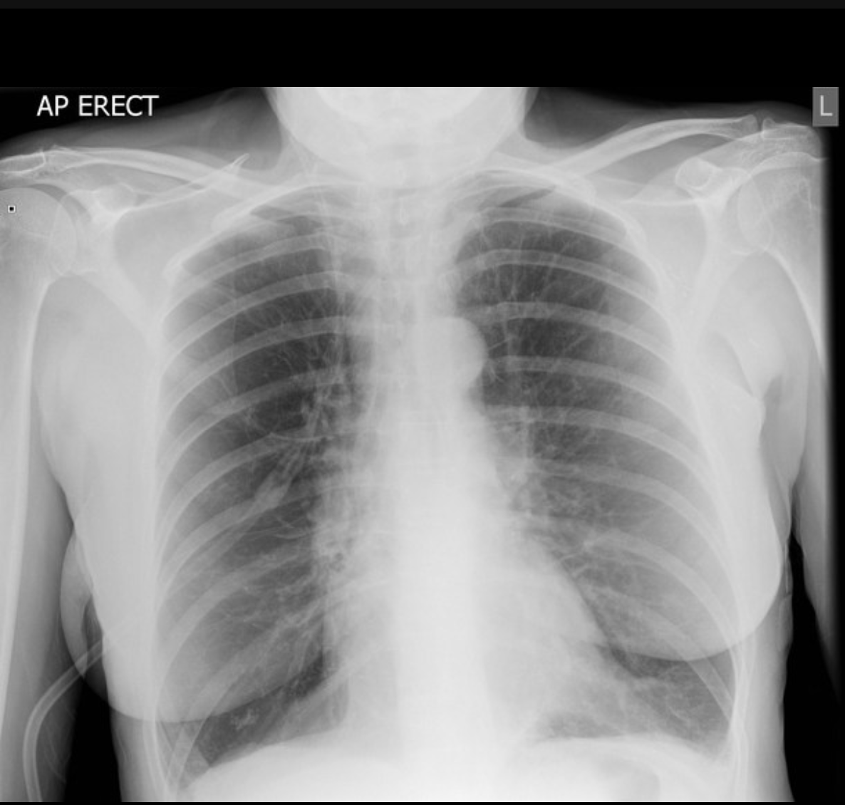 <p>What might a CXR show in an asthma exacerbation</p>