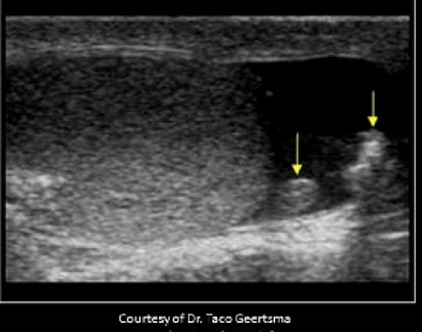 <p>The arrows indicate a remnant of the Mullerian duct and a scrotal calcification.</p>