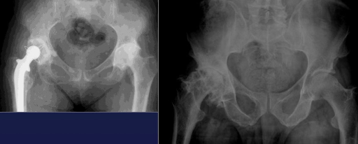 <p>Coxarthrosis</p>
