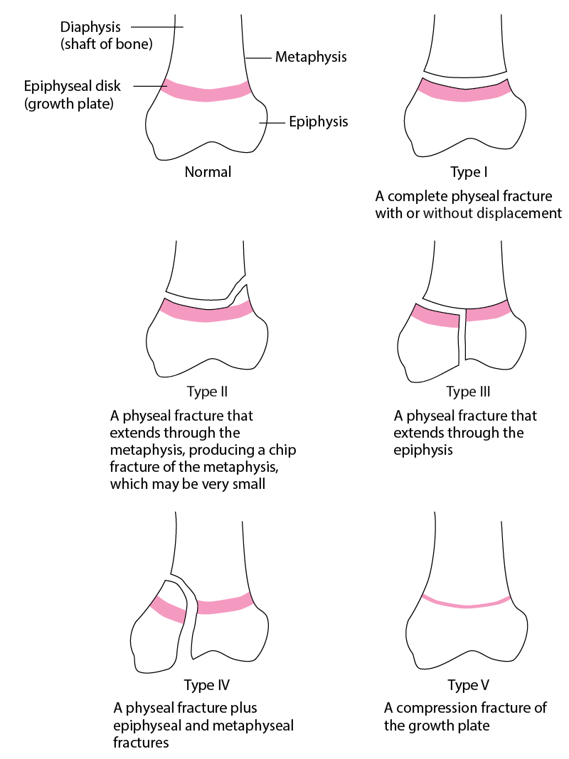 occur where bone matrix is calcifying (a clean transverse fracture of this type heals well)