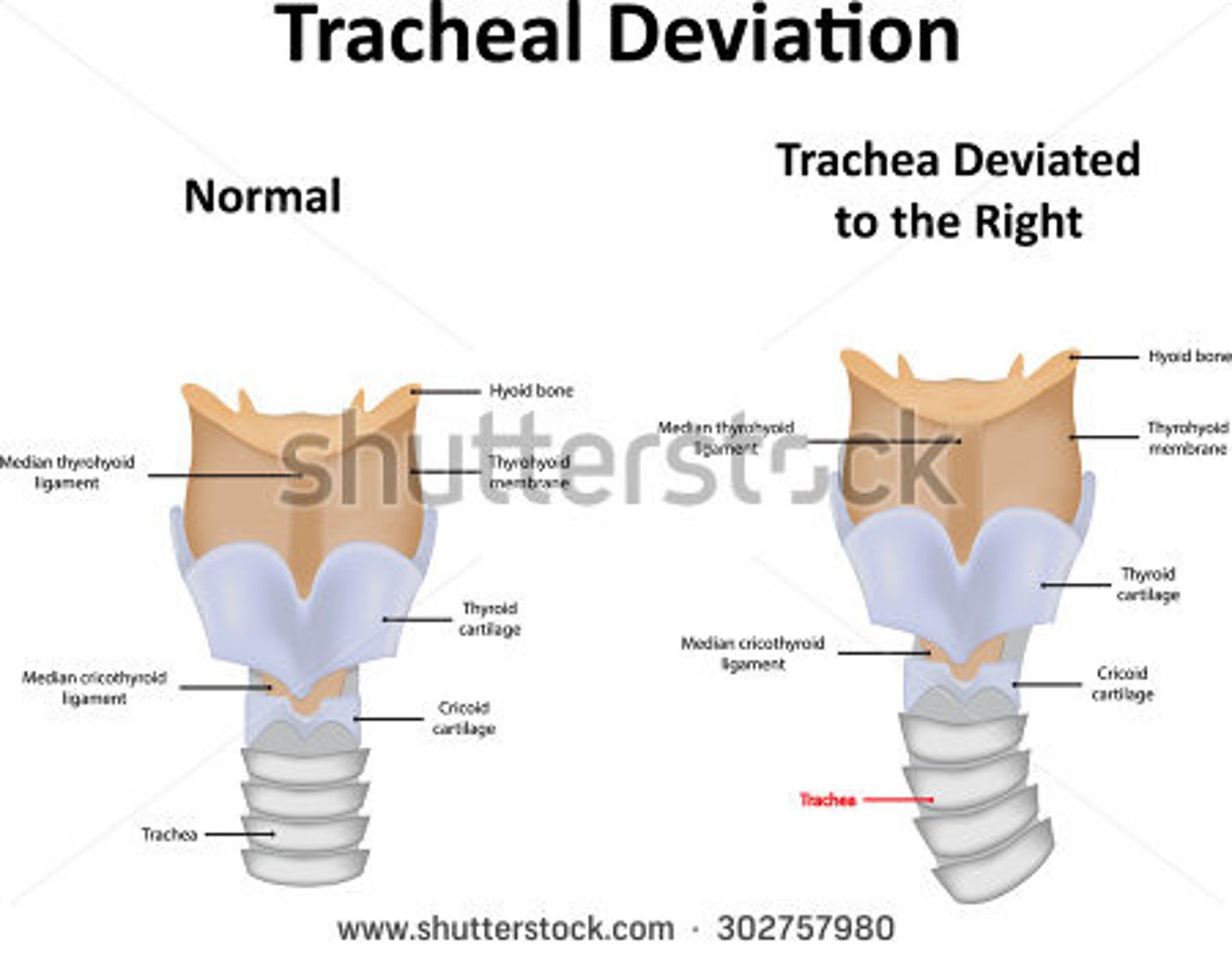 <p>Trachea deviation is associated with problems within the chest.</p><p>Trachea pushed away from affected side:</p><p>-Thyroid enlargement</p><p>-Pleural effusion</p><p>-Tension pneumothorax</p><p>Trachea pull toward affected side:</p><p>-Pulmonary fibrosis</p><p>-Atelectasis/Collapsed lung</p>