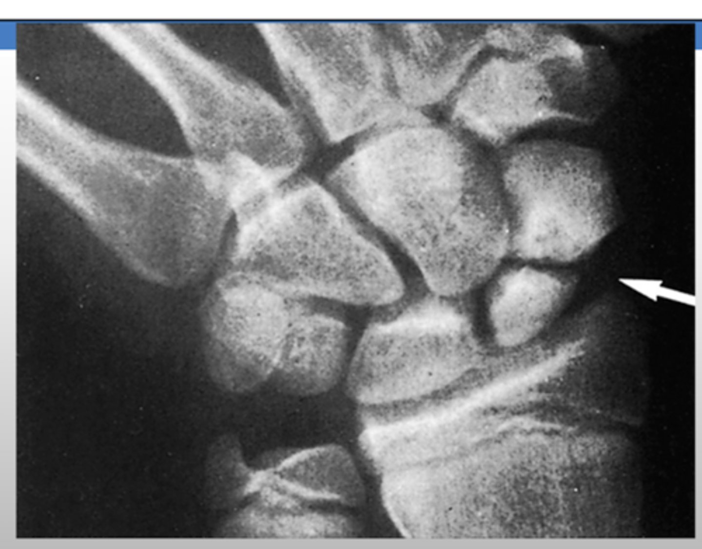 <p>scaphoid view</p><p>- PA view with wrist in an ulnar deviation</p>