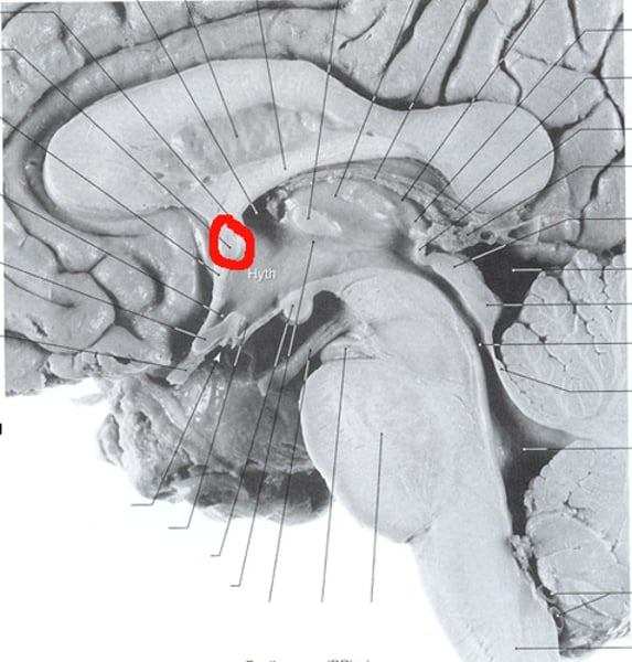 <p>Responsible for <strong>acute, sharp pain sensation</strong></p><ul><li><p>Connects L + R amygdala and ventromedial temporal cortices</p></li></ul>