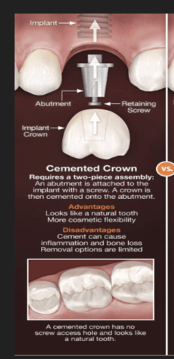 <p>screw in abutment to connect to body, the crown is cemented to the abutment</p><p>usually anterior teeth</p>