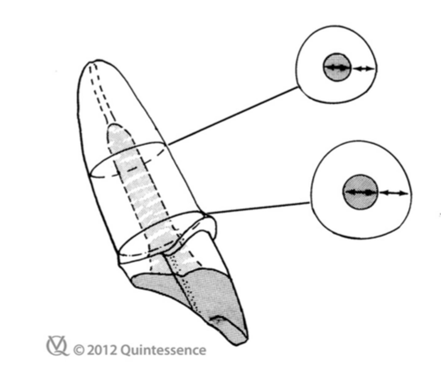 <p>Dowel diameter should be no more than _____ the root diameter at the cementoenamel junction. It should be at least _____ mm less than the crown diameter at midroot</p>