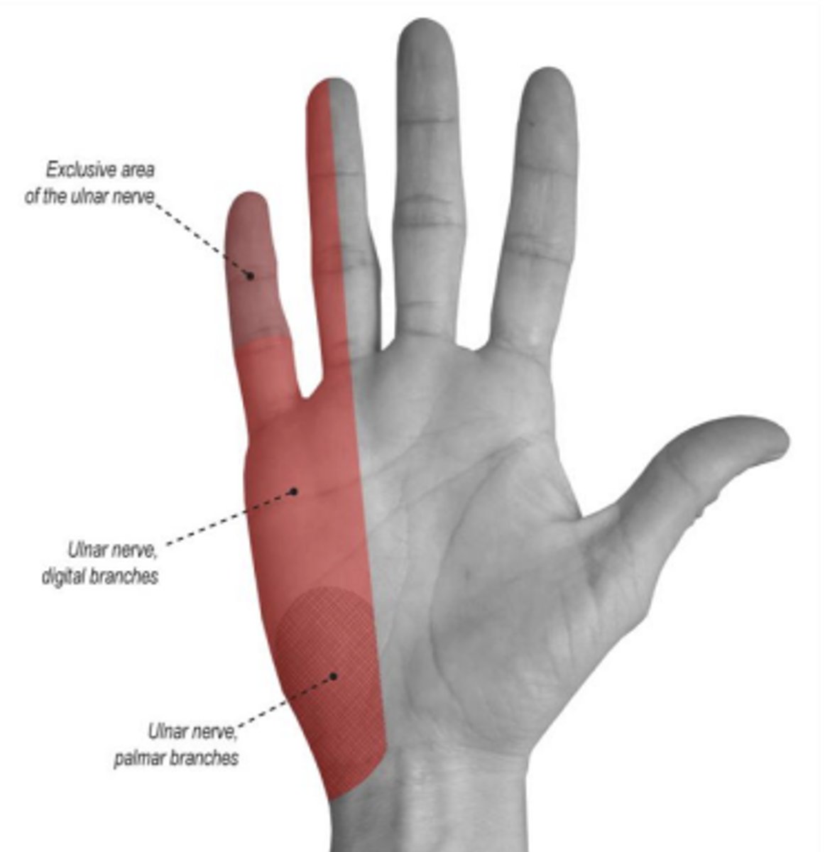 <p>Numbness, paresthesias, and pain in the medial hand, fifth digit, and half of the fourth digit, often with intrinsic hand muscle weakness.</p>
