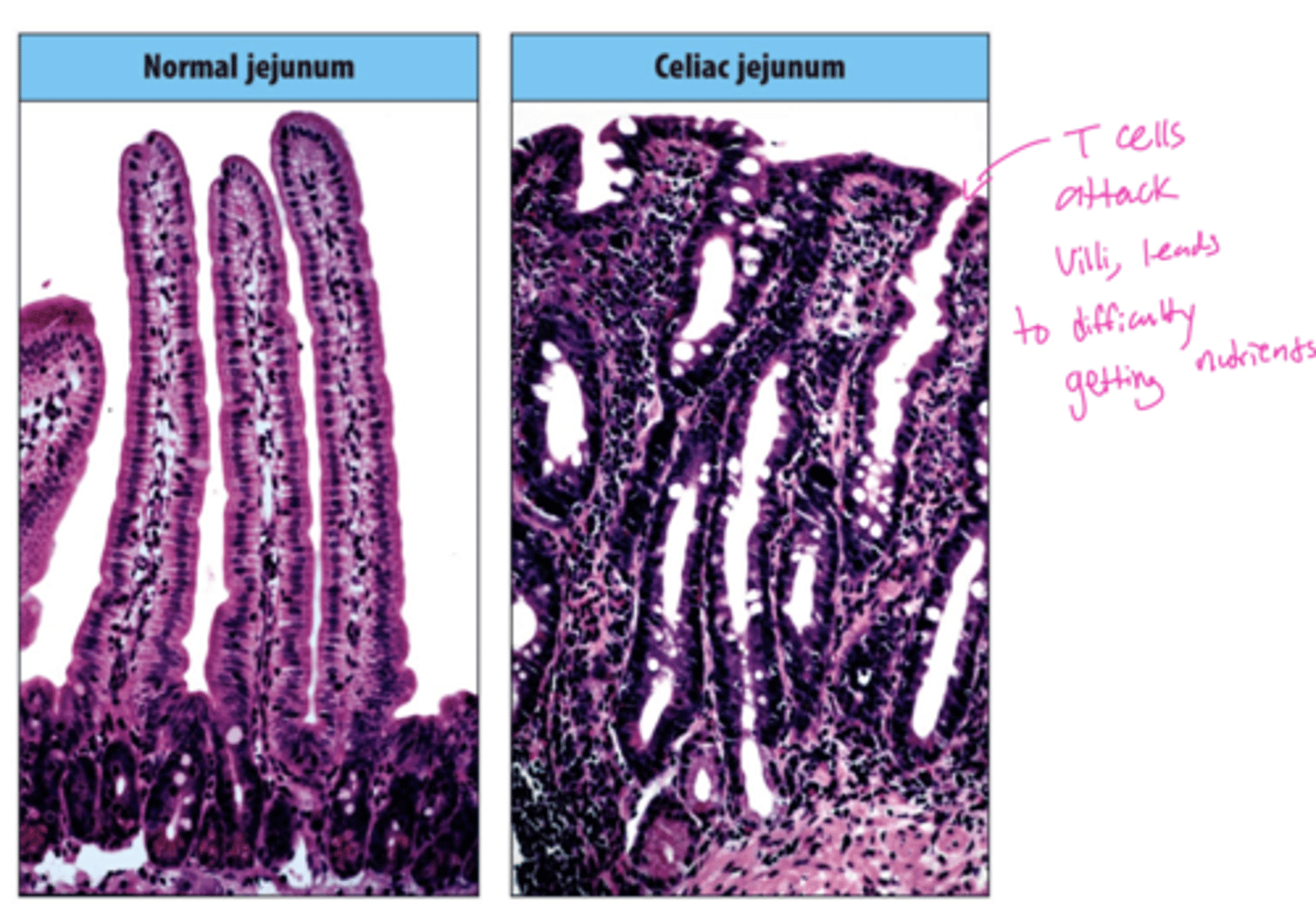 <p>A: Macrophages activated by Th1 cells.</p>