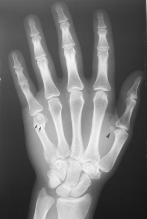 <p>Boxer (fracture)</p>