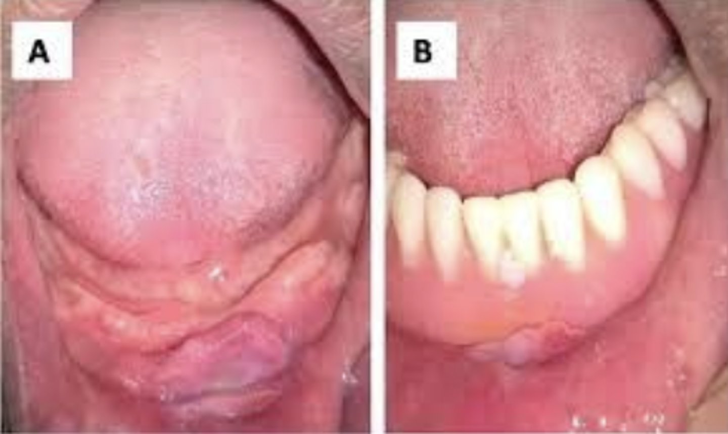 <p>What are ddx for epulis fissuratum? (wasn't this exact image, but similar) What is the tx?</p>