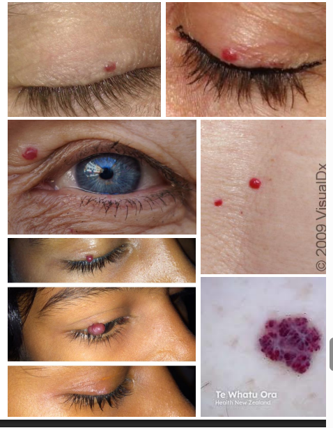 <p>• Solitary, distinct, elevated and movable</p><p> • Small lesions are red </p><p>• Larger lesions are red-blue</p>