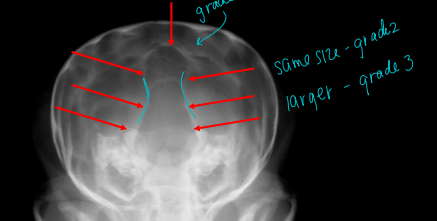 <p>Occipital Dysplasia</p>