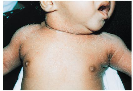 <p>miliaria</p>