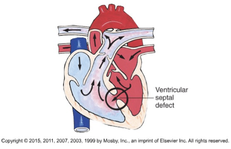 <p>a hole in ventricular septum and heart is tipped slightly to right</p><p>Blood will flow from left to right due to gravity</p><p>right atrium will get way bigger than it should—> HF</p>