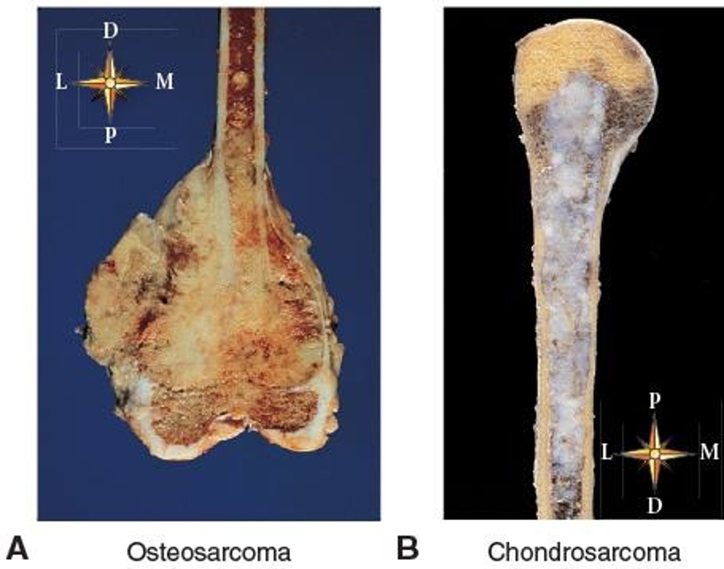 <p>bone cancer usually at the metaphysis of a long bone (like the femur)</p><p>most common bone cancer in adolescents</p><p>usually peaks during adolescence and overlaps with growth spurts (around age 15)</p>