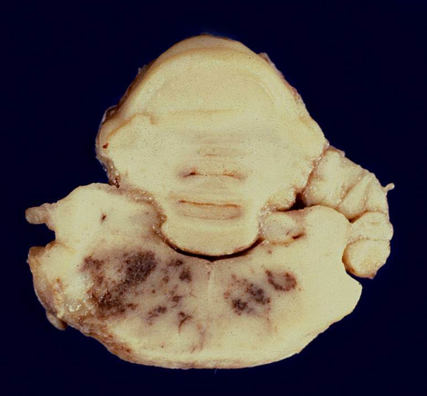 <p>3.<span>&nbsp; </span>Tissue from a sheep.<span>&nbsp; </span>Which of the following is true concerning this agent?<br></p><ol><li><p>This agent may utilize axonal transport mechanisms to infect the central nervous system.</p></li><li><p>Lesions associated with sepsis will be seen in various organs, especially the liver in this individual.</p></li><li><p>This Gram-negative organism is resistant to harsh environmental conditions including low temperatures and low pH.</p></li><li><p>This viral disease is generally preceded by mild, often inapparent respiratory disease.</p></li></ol><p></p>