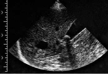 <p><span>Which of the following pathologies is also dem- onstrated in the sonogram?<br></span></p>