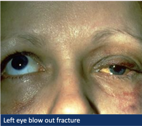 <ul><li><p><strong>Bruising</strong>, tenderness, periorbital <strong>swelling</strong></p></li></ul><p></p><ul><li><p><strong>Double vision </strong>→ eye tethered so won’t look up</p></li></ul><p></p><ul><li><p><u>Loss of sensation in cheek</u> → infraorbital nerve trapped</p></li></ul><p></p><p></p>