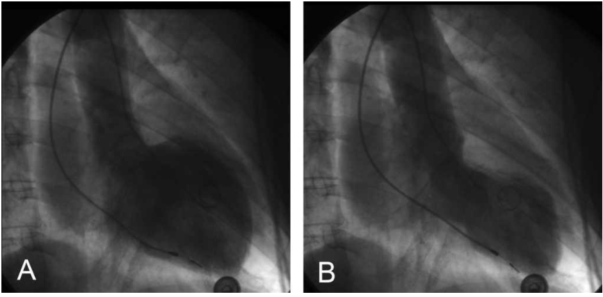 <p>what is the rating of mitral regurg</p>