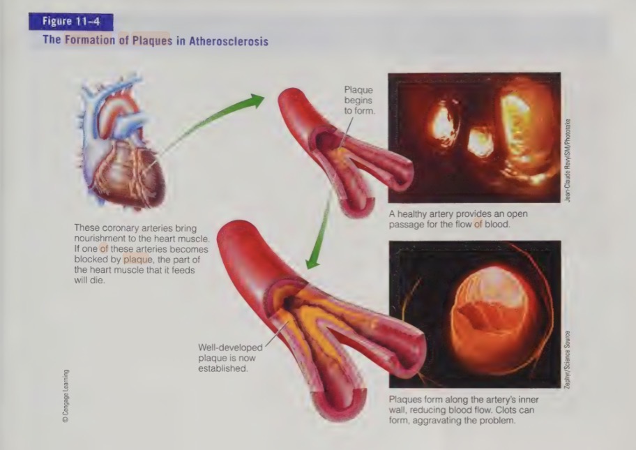 <p>mounds of lipids materials mixed with smooth muscle cells and calcium</p>