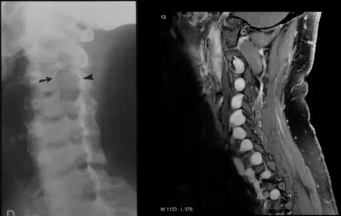 <p>What is this?</p><p>Ex. Pt has Fibroma Molluscum, Cafe Au Lait spots + Coast of California, Kyphoscoliosis</p>
