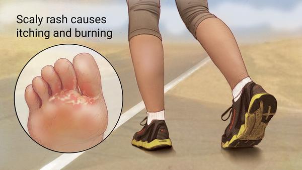 Spore-producing organisms   ex. Athlete's Foot