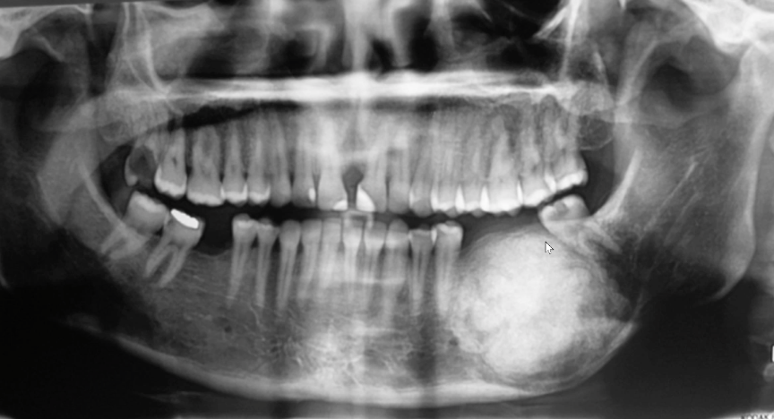 <p>EXPANSILE RO lesion causing tooth and IAC displacement, likely diagnosis?</p>