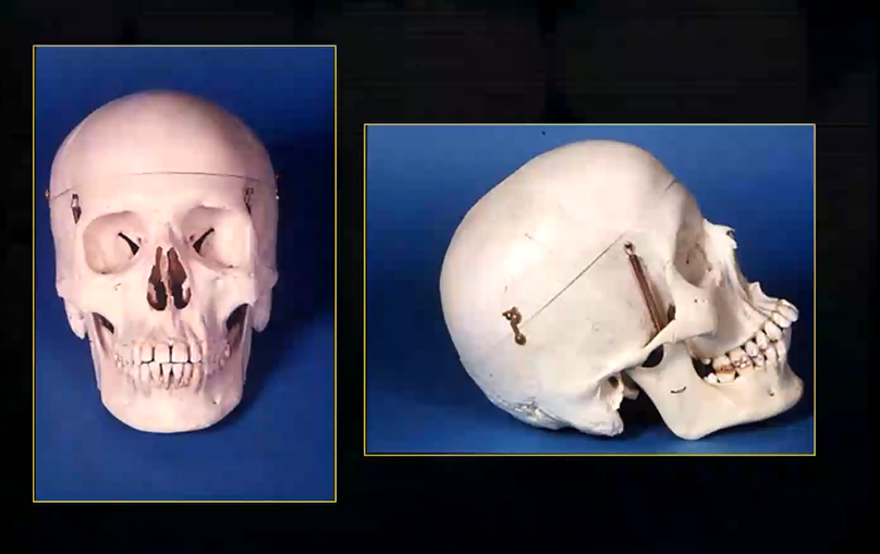 <ul><li><p>soft tissue shadowing, is for the most part, not relevant</p></li><li><p>it is important that you are aware of the whole skull but particularly the <strong>maxilla and the mandible </strong></p></li></ul><p></p>