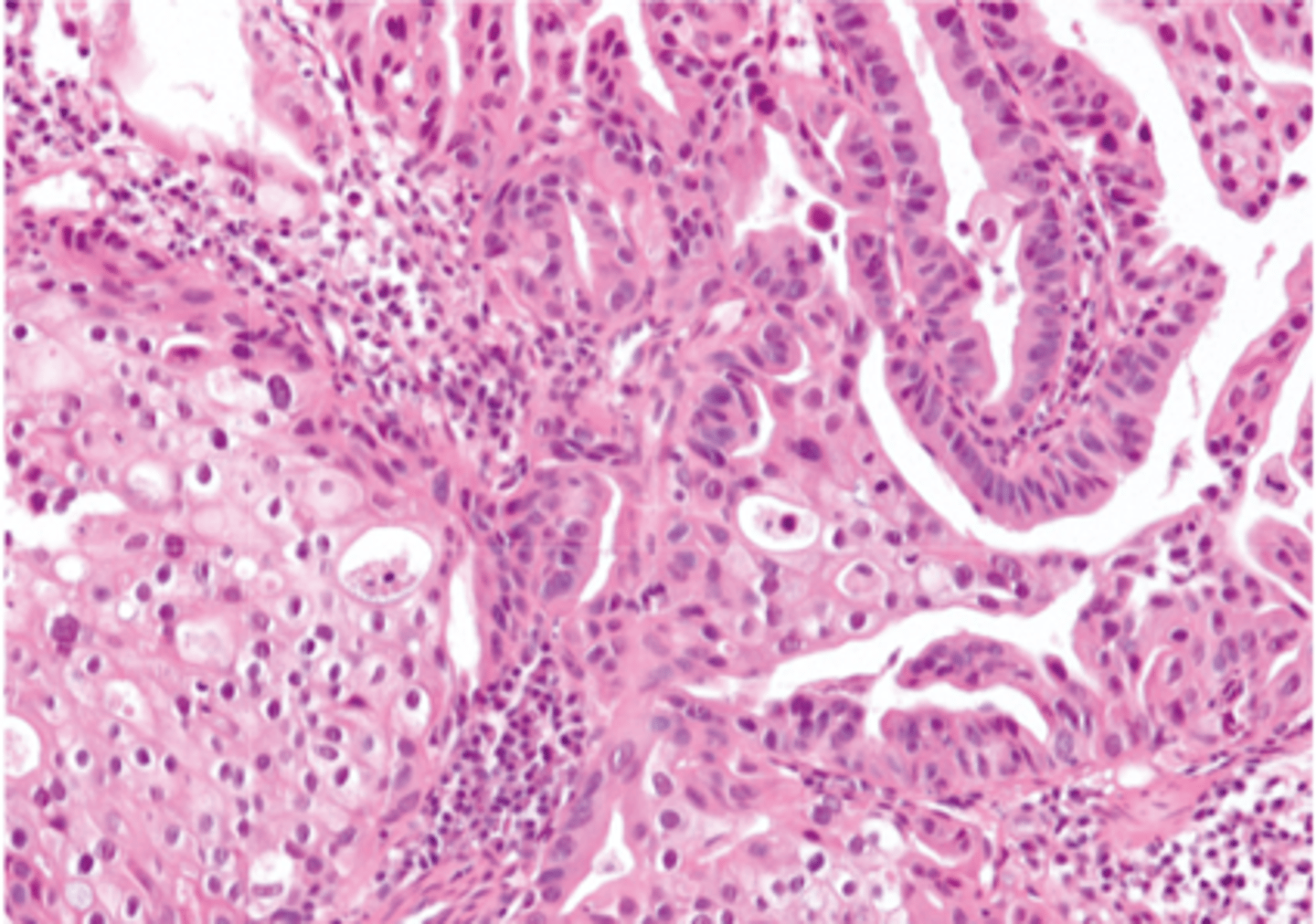 <p>What is observed microscopically in prostatic carcinoma?</p>