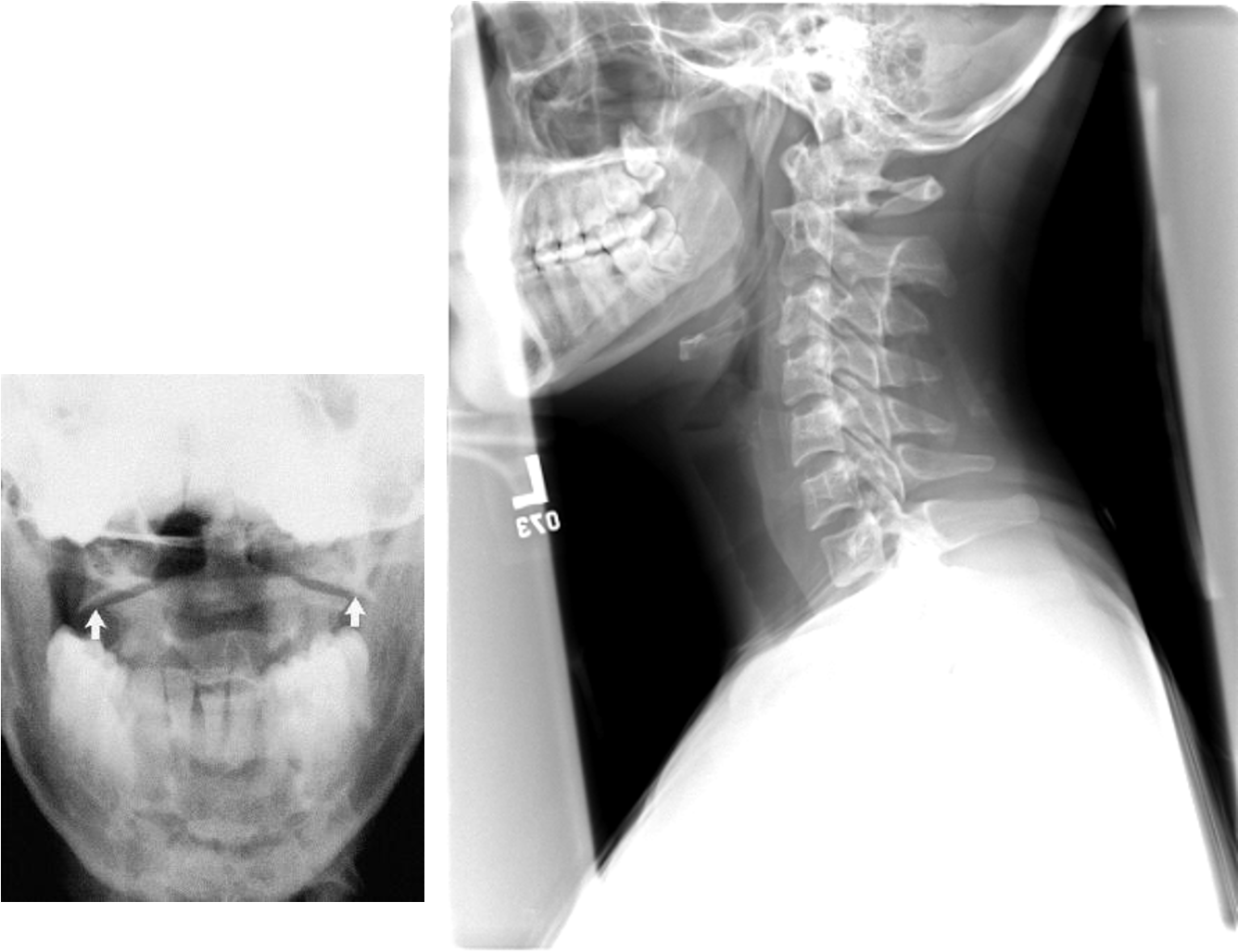 <p>burst fx of C1 </p><p>due to axial loading of head being smashed down onto spine</p>