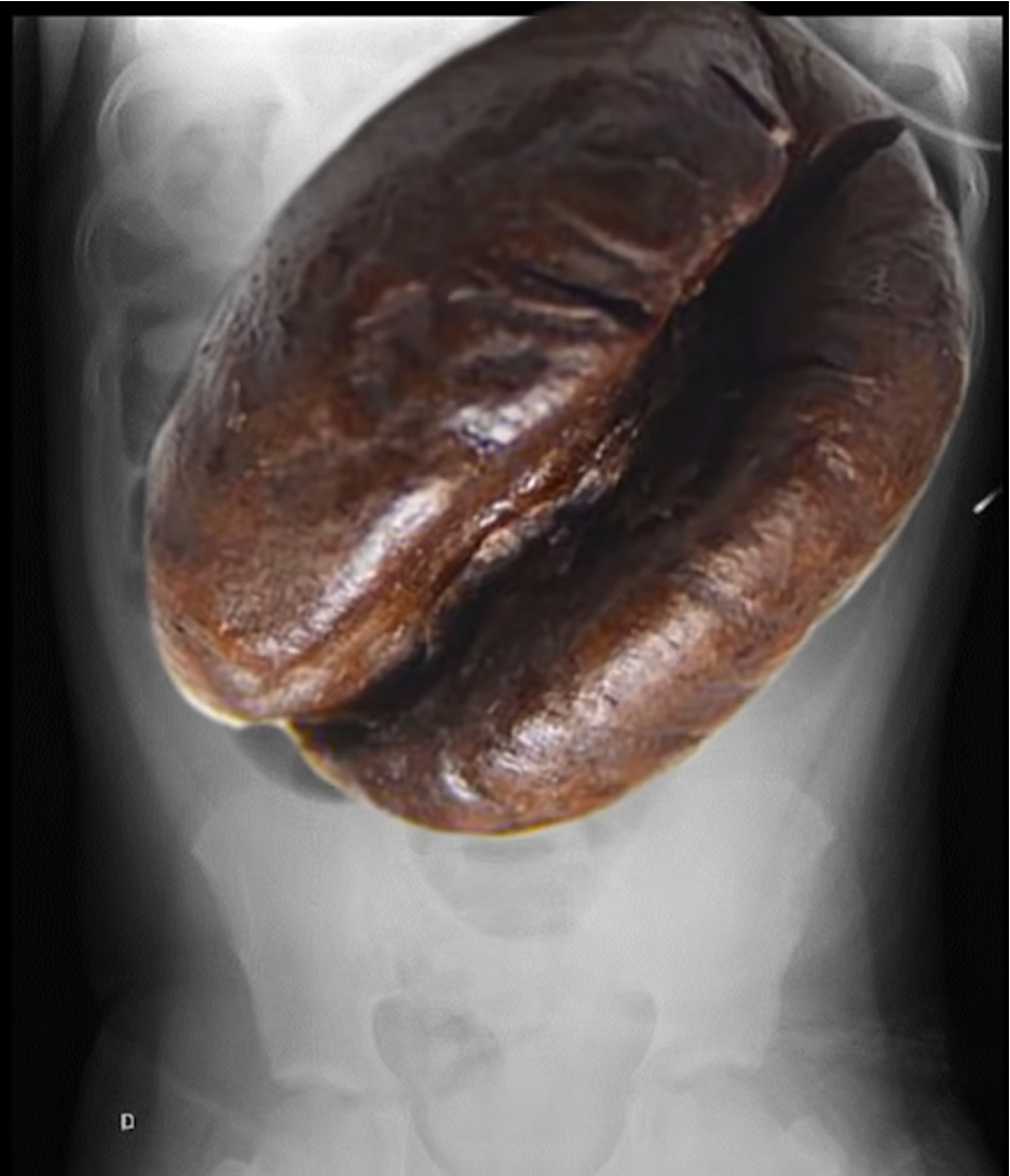 <p>when the cecum or sigmoid twists upon itself</p><ul><li><p>Coffee bean appearance</p></li><li><p>considered a LBO</p></li><li><p>massively dilated colon and haustra are absent</p></li></ul><p></p>