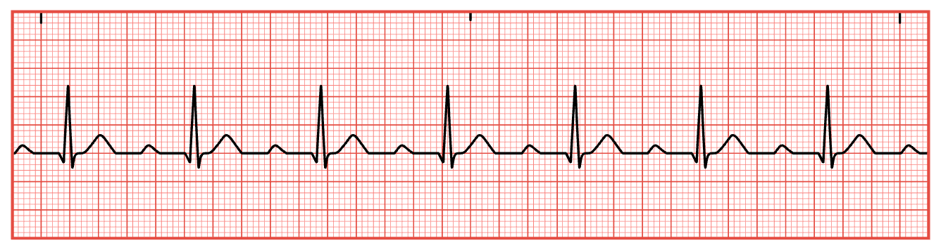 <ol type="1"><li><p><span style="font-family: &quot;Times New Roman&quot;;">Calculate heart rate.</span></p></li><li><p><span style="font-family: &quot;Times New Roman&quot;;">Determine if heart rhythm is regular.</span></p></li><li><p><span style="font-family: &quot;Times New Roman&quot;;">Assess for P waves.</span></p></li><li><p><span style="font-family: &quot;Times New Roman&quot;;">Measure PR interval.</span></p></li><li><p><span style="font-family: &quot;Times New Roman&quot;;">Measure duration of QRS complex.</span></p></li></ol><p></p>