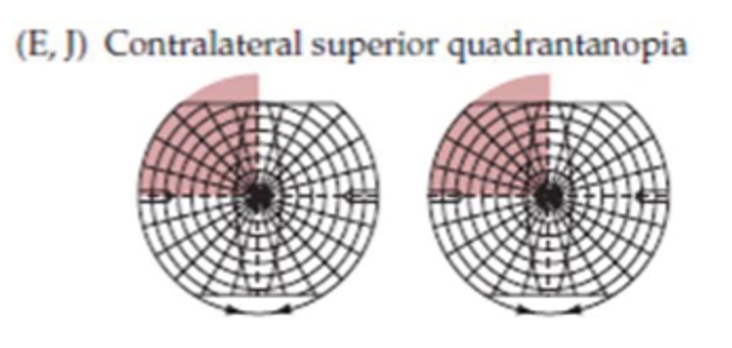 <p>Contralateral superior quadrantanopia</p>