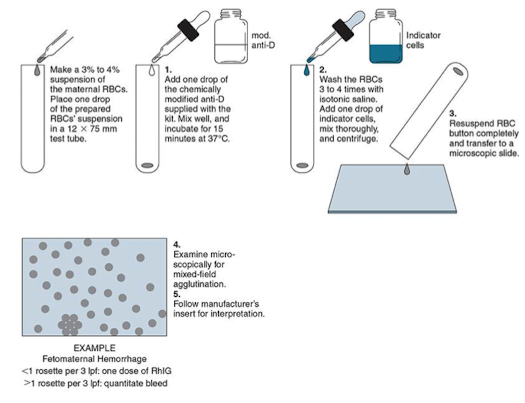 <ul><li><p>≤1 rosette/3 low-power fields: 1 RhIG dose.</p></li><li><p>&gt;1 rosette/3 low-power fields: Quantify bleed needed.</p></li></ul><p></p>