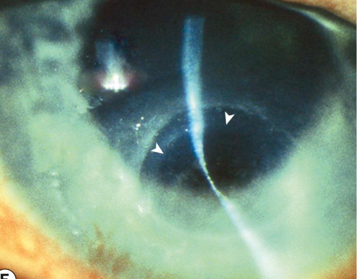<ul><li><p><em>protrusion</em> of Descemet membrane into the anterior layers of the cornea</p></li><li><p>seen w/ severe ulceration</p></li></ul><p></p>