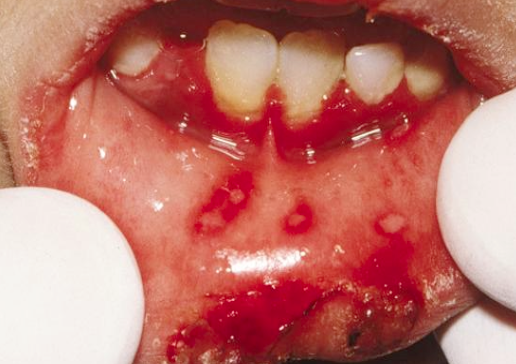 <p>What is the management of primary herpetic gingivostomatitis?</p>