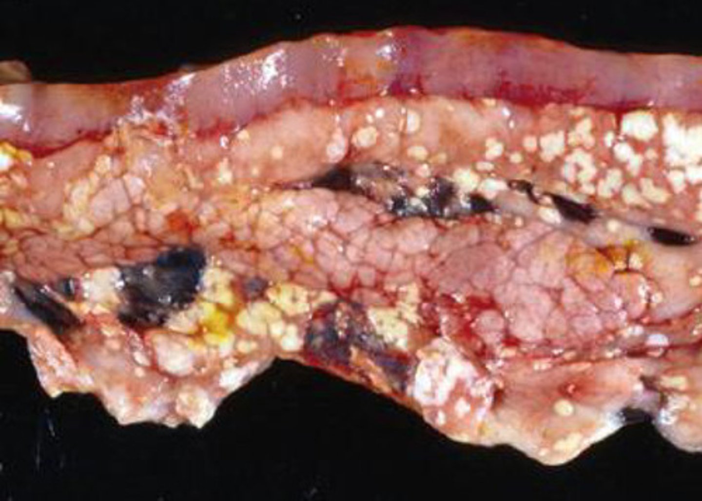 <p>What kind of necrosis is shown?</p>