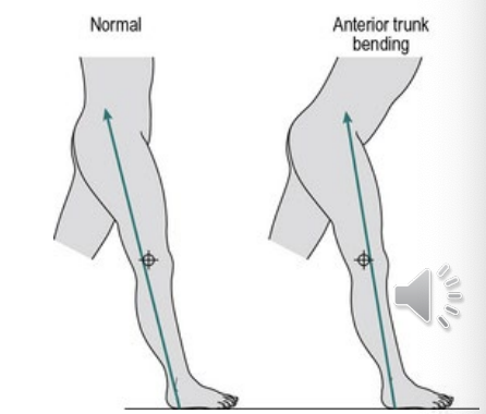 <p><strong><em>Terminal Swing (Prosthetic side - long step)</em></strong></p><p>Characterized by fixed relationship between the trunk and the limb. Patient does not have the ability to extend on the prosthetic side </p><p>Potential Cause </p><ul><li><p>insufficient initial socket flexion (unaccommodated hip flexion contracture)</p></li></ul><p></p>