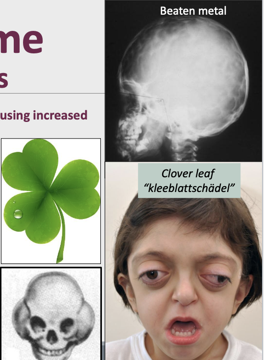 <ul><li><p><span style="color: #000000">Ocular proptosis (Bulging of the eye)</span></p></li><li><p><span style="color: #000000">Abnormal skull shapes: Clover leaf (kleeblattschädel)</span></p></li><li><p><span style="color: #000000">Intra-oral: Maxillary hypoplasia, crowded teeth</span></p></li><li><p><span style="color: #000000">Radiograph: “beaten metal” pattern</span></p></li><li><p><span style="color: #000000">Clover leaf “kleeblattschädel”</span></p></li></ul><p></p>