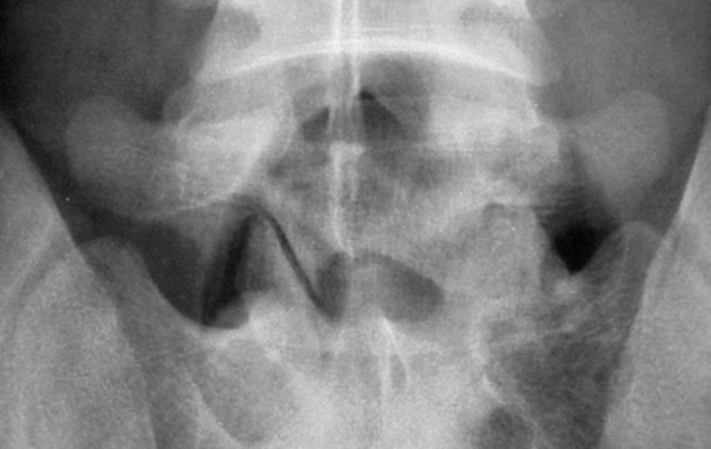 <p>"Trop" = to turn</p><p>Asymmetric orientation of the facets = coronal AND sagittal facets at one level</p>