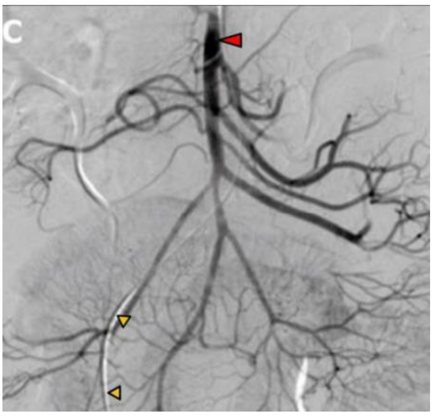 <p>An arteriogram from a 33-year-old female with abdominal pain reveals the image shown in the accompanying image. The catheter (orange arrowheads) is in what vessel?</p><p>A. External iliac</p><p>B. Femoral</p><p>C. Inferior rectal</p><p>D. Internal iliac</p><p>E. Internal pudendal</p>