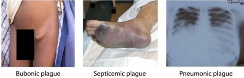 <ul><li><p><strong>Bubonic:</strong> Bacterial growth in blood and lymph causing painful, swollen nodes called <strong>buboes</strong>.</p></li><li><p><strong>Septicemic:</strong> Causes fever, chills, extreme weakness, shock, and bleeding into the skin and organs, which can turn skin and other tissues black</p></li><li><p><strong>Pneumonic:</strong> Leads to rapidly developing pneumonia with symptoms like chest pain, shortness of breath, and coughing. </p><ul><li><p>Most serious form and the only one directly spread from <strong>person to person</strong> through infectious droplet</p></li></ul></li></ul><p></p>