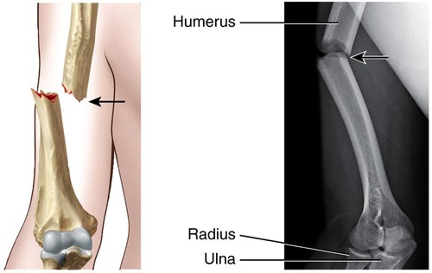 <p>skin is open, greater infection risk</p>