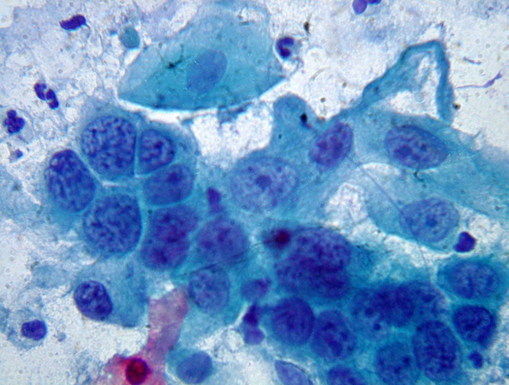 <p>Diathèse tumorale, atypies importantes nucléole proéminent </p><p>1) diagnostic principal</p><p>2) dd pertinents</p><p>3) clés d’exclusion</p><p>4) conduite</p>