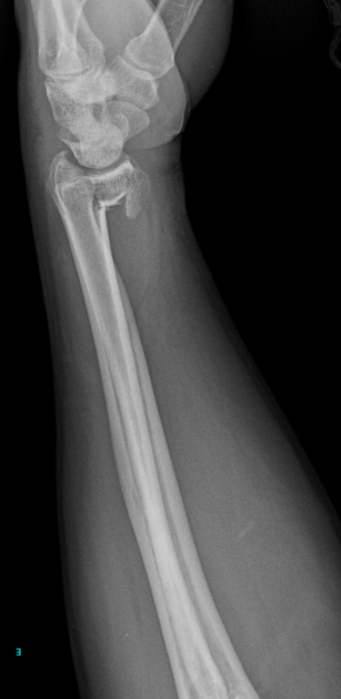 <p>Describe the abnormality demonstrated.</p>