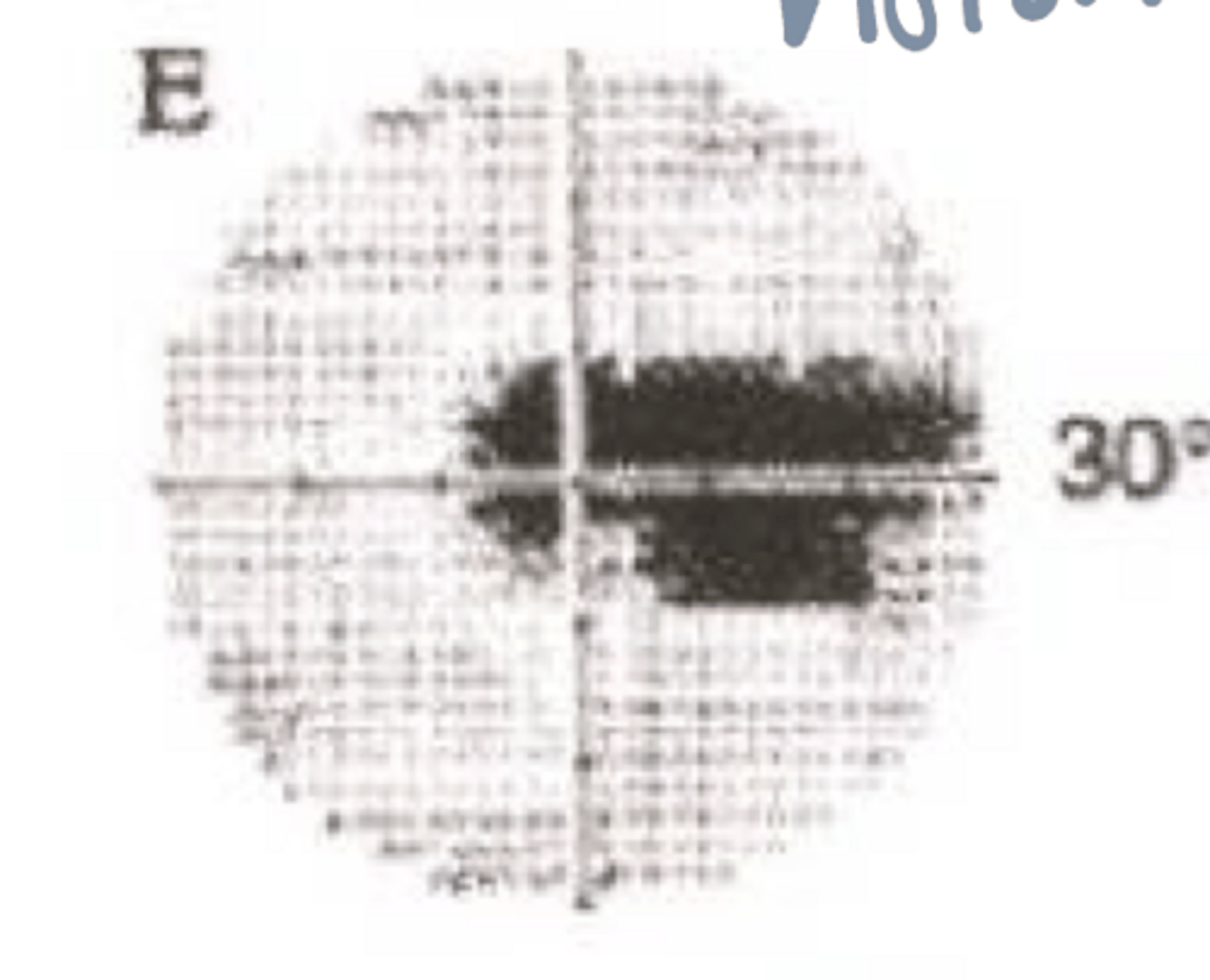 <p>What type of monocular pre-chiasmic VF defect is present in the given image?</p>