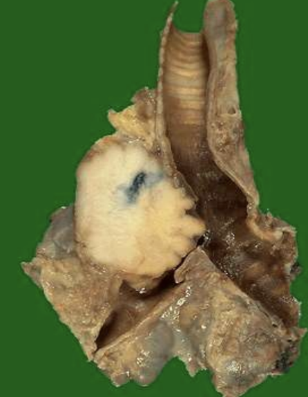 <p>Malignant tumor of squamous epithelium, e.g., cervix or lung.</p>