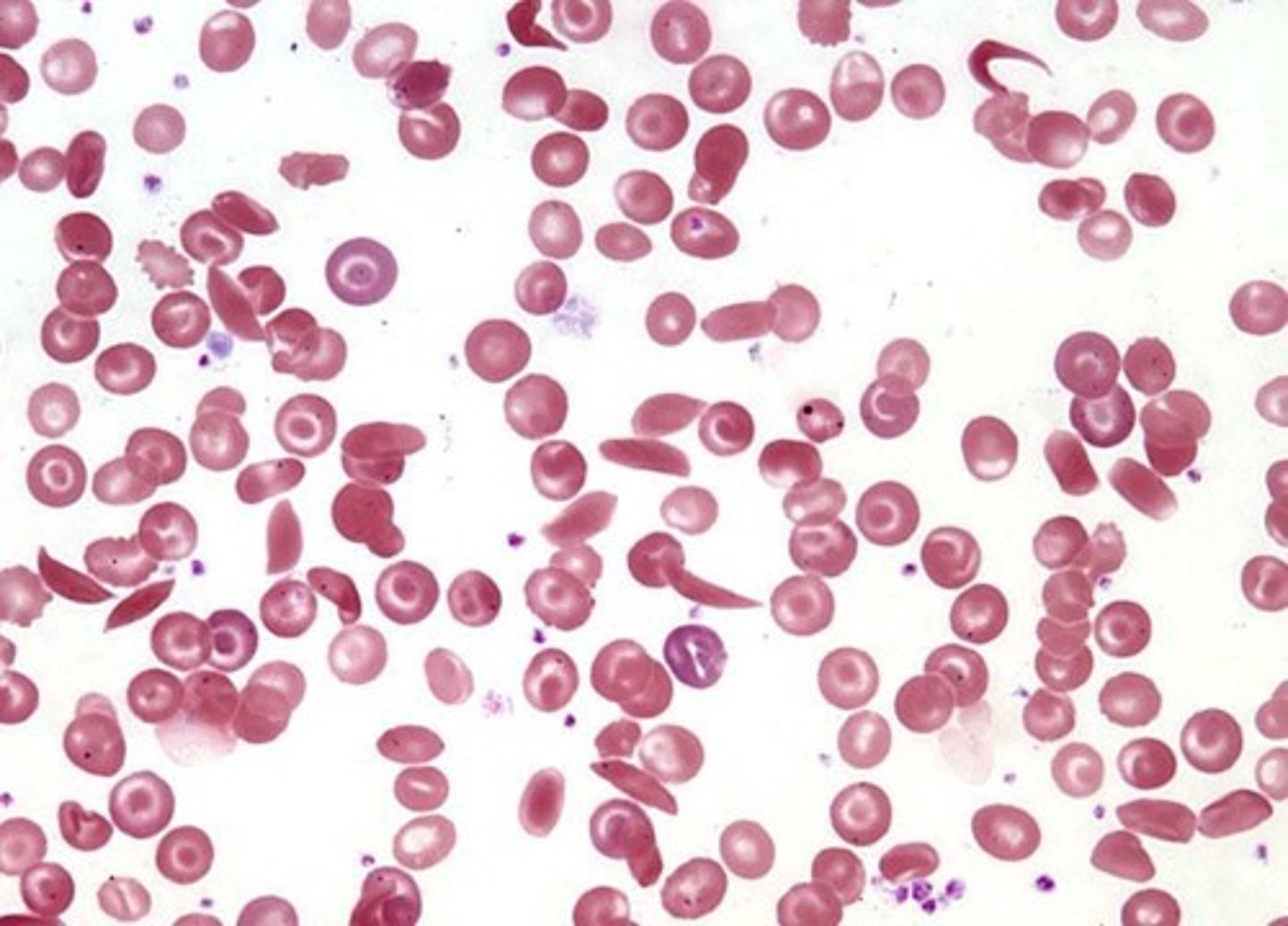<p>Abnormal red blood cells in sickle cell anemia.</p>