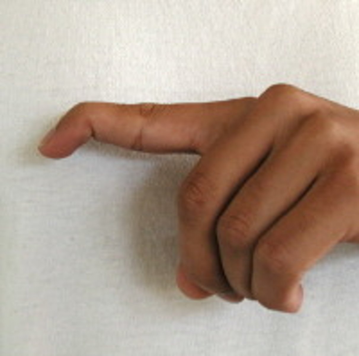 <p>due to rupture or avulsion of the extensor tendon at distal phalanx of finger, distal phalanx rest in flexed</p><p>position.</p>