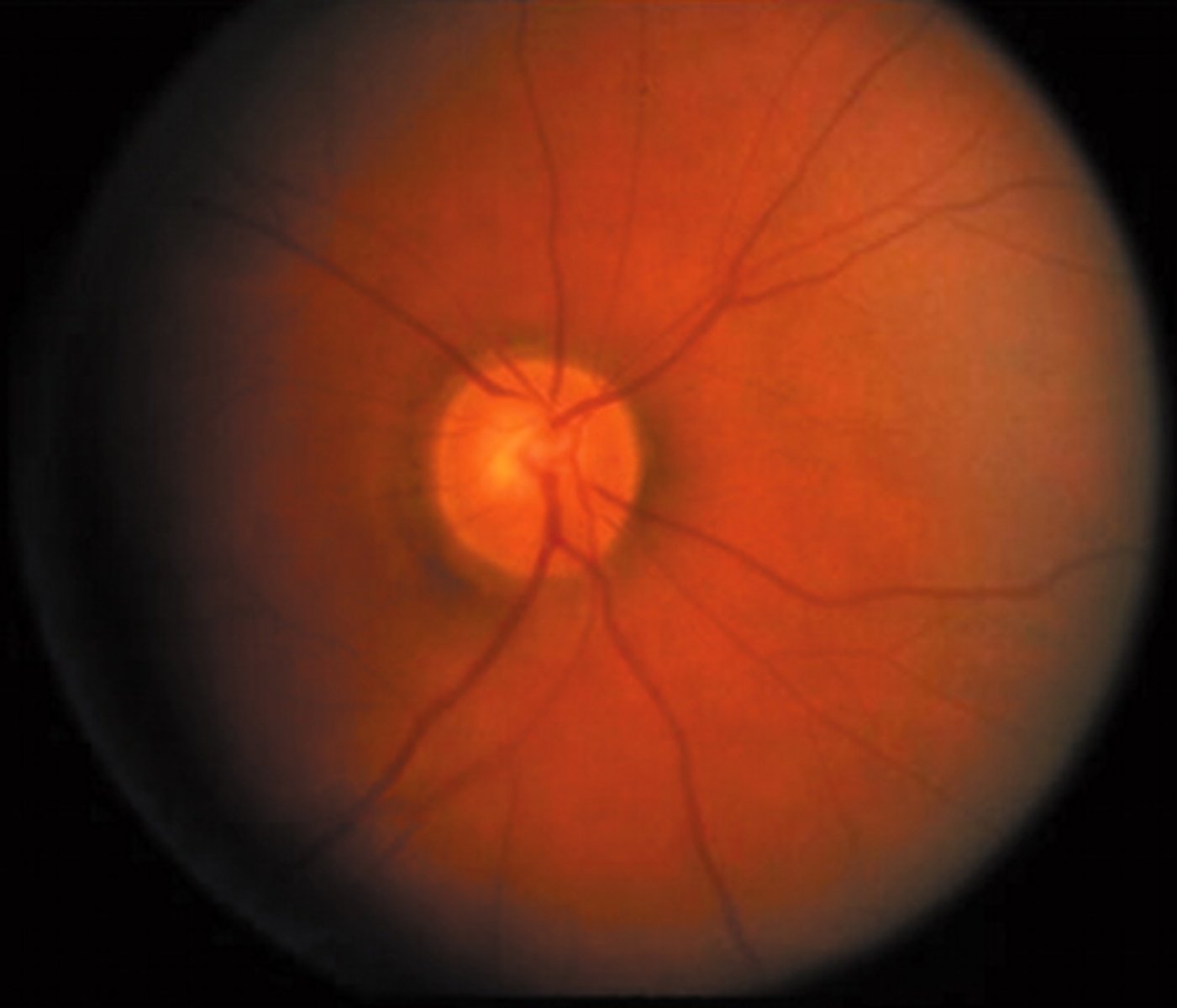 <p>-Irreversible</p><p>-Damage and thickening of arterial wall</p><p>-Caliber of arterioles is reduced</p><p>-Best observed about 1DD out</p><p>-Attenuation of arterioles (Normal A/V=2/3)</p><p>-Thickening of arterial light reflex (normal ALR=1/3)</p>