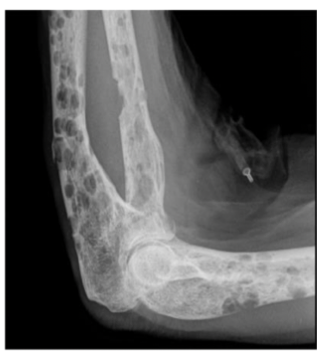 <p>48 y/o male presents to the clinic for elbow pain and fatigue. He states that his arm just hurts DEEP. Basic labs reveal an elevated creat, hypercalcemia, low Hgb, low Hct, and low RBCs. X-rays reveal punched out lesions. What is your treatment plan?</p>